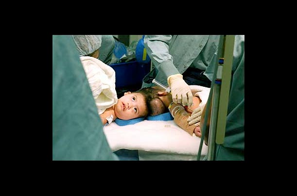 Maria de Jesus Alvarez watches as anesthesiologists at UCLA Medical Center prepare for the operation that separated herconjoined twin