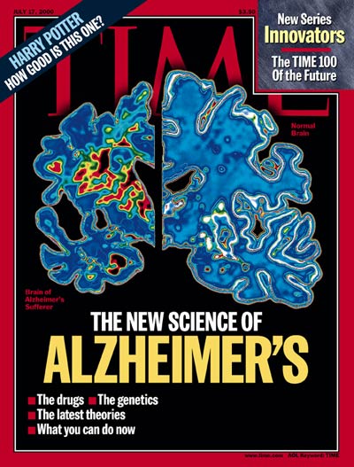 Scans of healthy brain (R) and brain afflicted w. Alzheimer's disease (L);  .